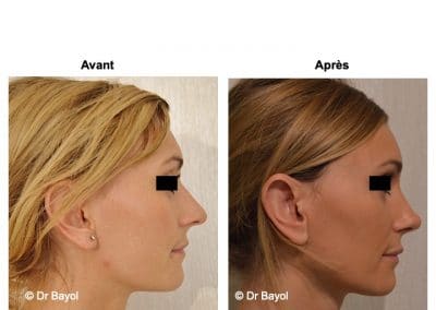 rhinoplastie Annecy