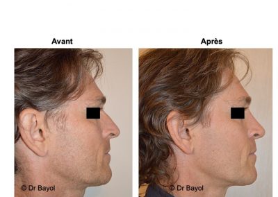 rhinoplastie Chambery