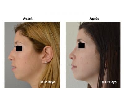 rhinoplastie Genève