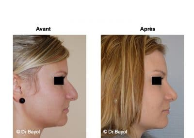 rhinoplastie Grenoble