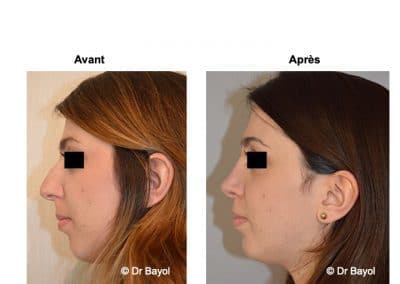 rhinoplastie Lausanne