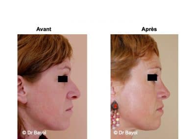 rhinoplastie Lyon