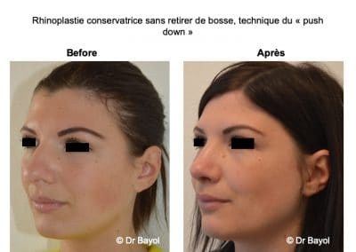 rhinoplastie acide hyaluronique Lyon