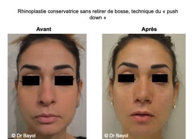 rhinoplastie conservatrice Lyon