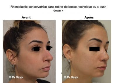 rhinoplastie fonctionnelle Lyon