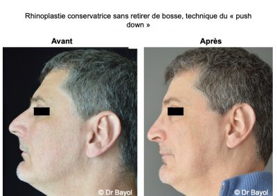 rhinoplastie médicale Lyon