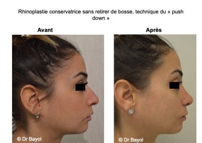 rhinoplastie push down Lyon