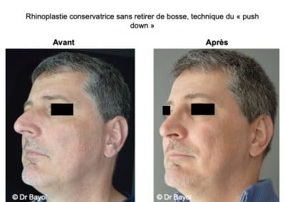 rhinoplastie ultra sonique Lyon