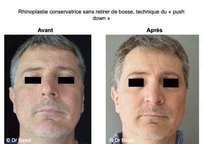 rhinoplastie ultrasonique Lyon