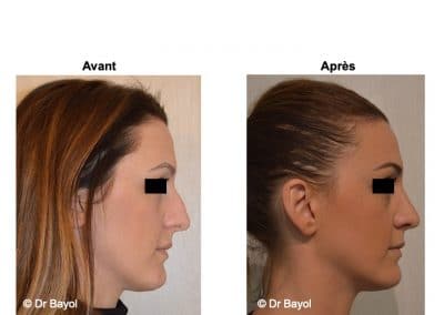 rhinoplastie à Lyon