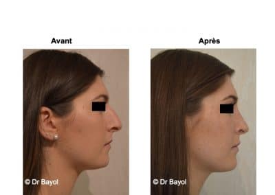 tarif rhinoplastie Lyon