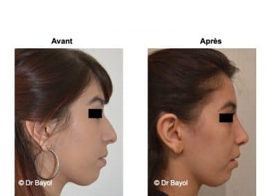 tarifs rhinoplastie Lyon