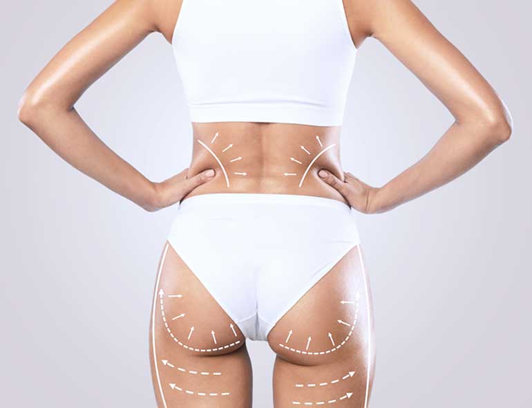chirurgie esthétique de la silhouette Lyon