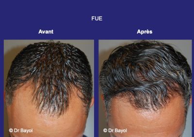 FUE greffe de cheveux Lyon