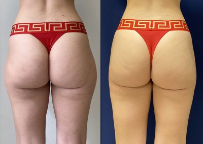 Lipoaspiration culotte de cheval lyon