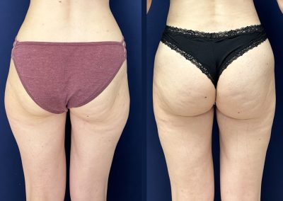 Liposuccion cuisses lyon