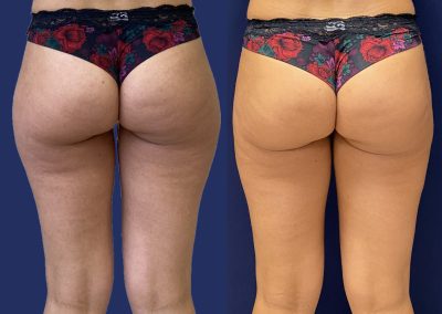 Liposuccion culotte de cheval lyon