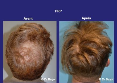 Lyon PRP cheveux