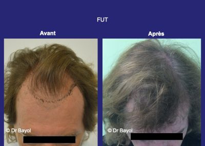 Lyon greffe capillaire