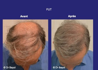Lyon greffe cheveux