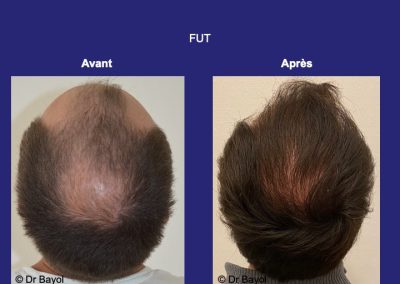 Lyon greffe de cheveux