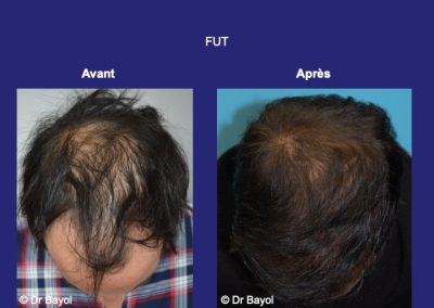 Lyon micro greffe de cheveux