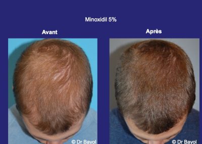 Minoxidil Lyon