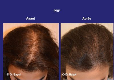PRP cheveux Lyon