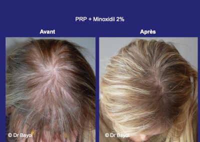 PRP cheveux femme Lyon