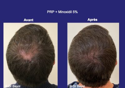 PRP cheveux homme Lyon
