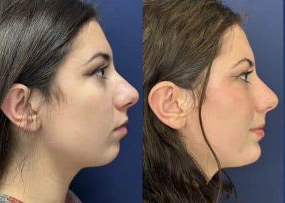 génioplastie médicale lyon