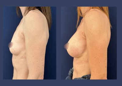 augmentation mammaire implants lyon