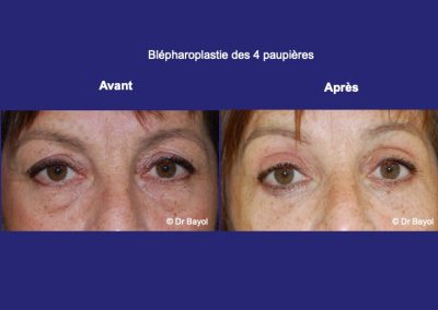 blépharoplastie 4 paupières lyon