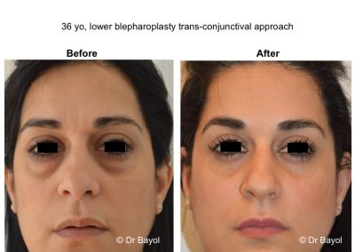 blépharoplastie genève