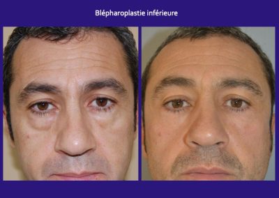 blépharoplastie inférieure homme lyon