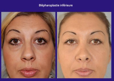 blépharoplastie inférieure lyon