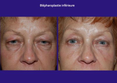 blepharoplastie inférieure lyon