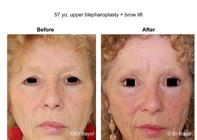 blépharoplastie lyon