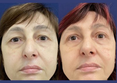 blépharoplastie supérieure