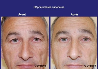 blépharoplastie supérieure homme lyon