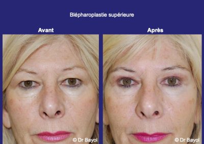 blépharoplastie supérieure lyon