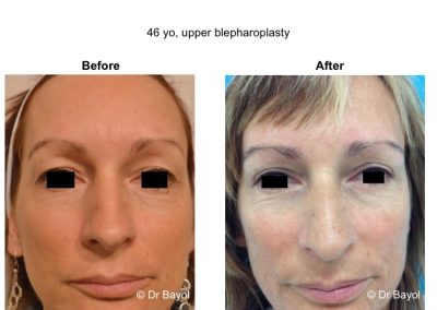 blepharoplastie superieure lyon