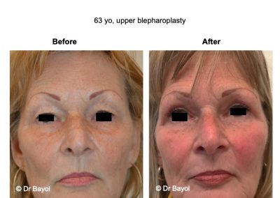 bon chirurgien blépharoplastie