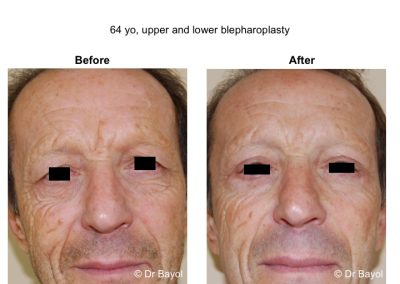 chirurgie esthétique des 4 paupières
