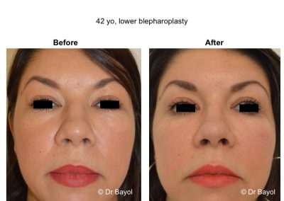 chirurgie esthétique des paupières inférieures