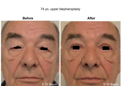 chirurgie esthétique des paupières supérieures