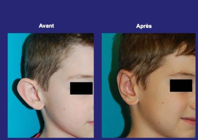 chirurgie oreilles décollées