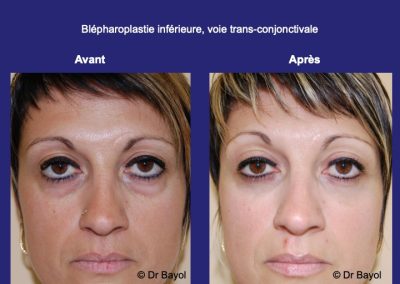 chirurgie poches yeux lyon