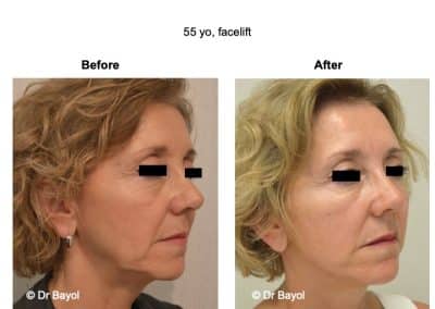 deep plane facelift lyon