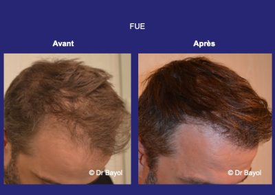 greffe FUE Lyon